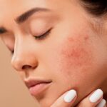 Vein and capillary treatment